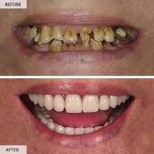 After — Dental implants