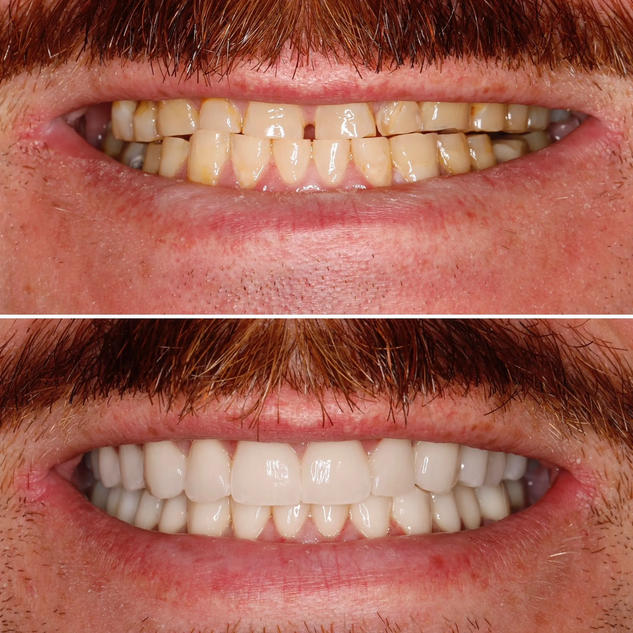 After — smile