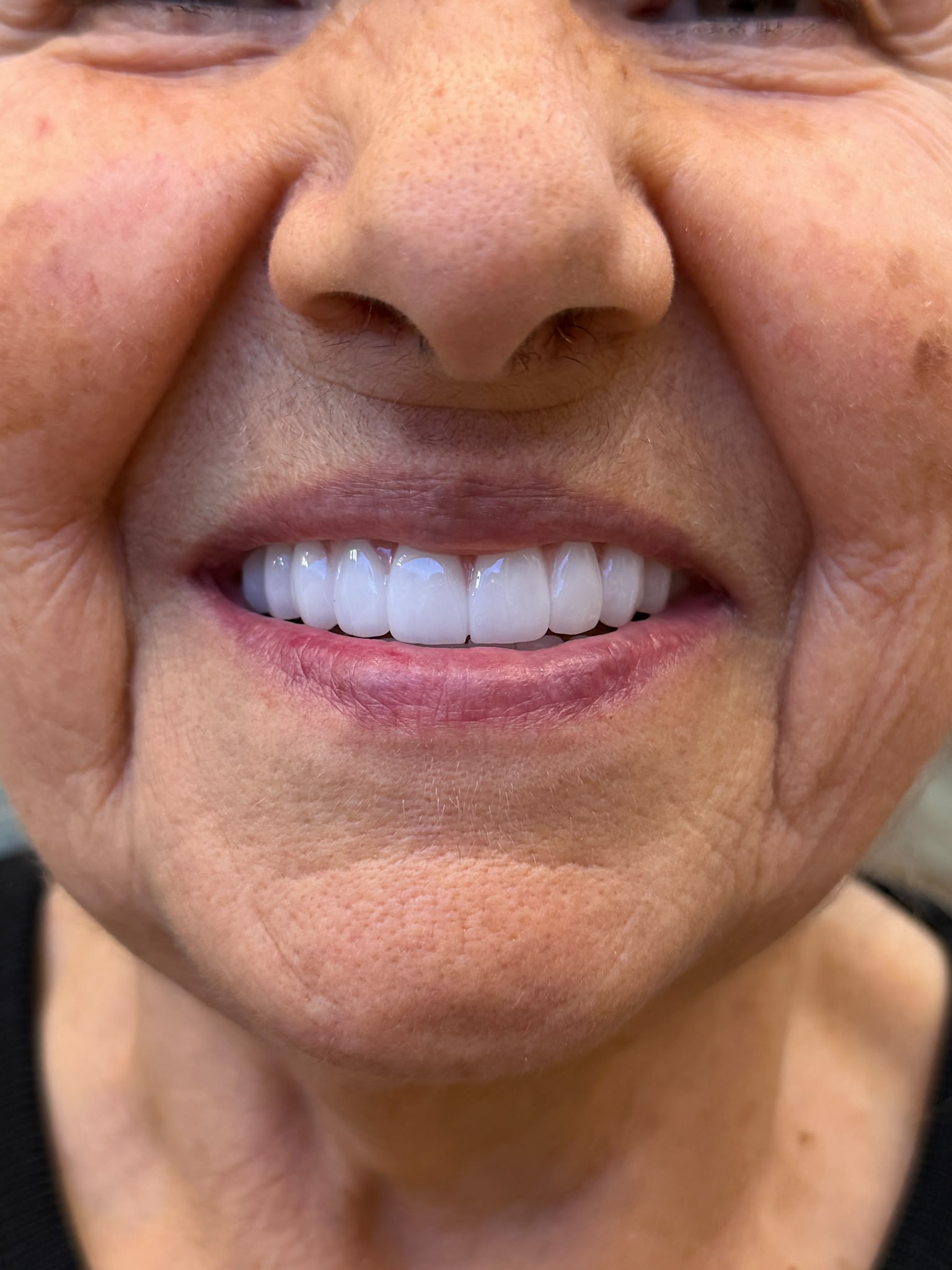 Before — Dent Simurg