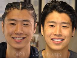 Before — smile