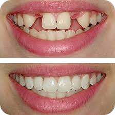 Before — Dental implants