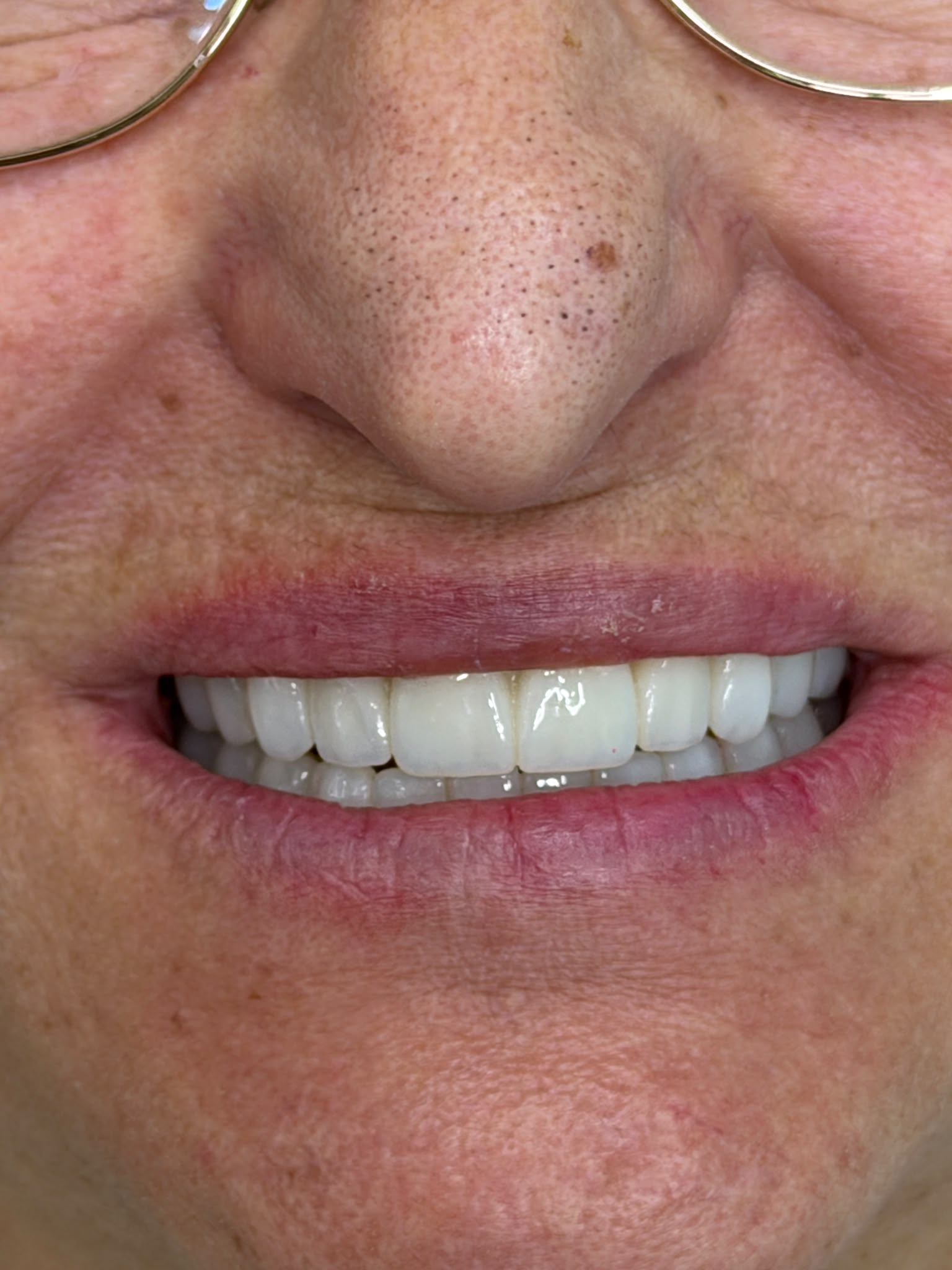 Before — Dent Simurg